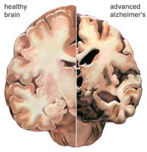 Alzheimer’s disease View of Brain
