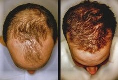 Hair loss sample of male's head