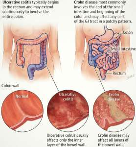 Inflammatory Bowel Disease Chart