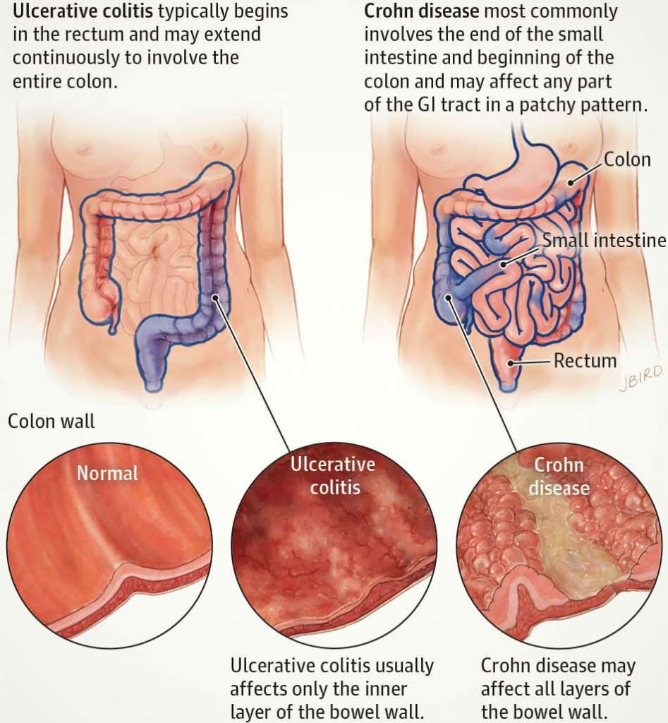 Inflammatory Bowel Disease Life Management For You 1938