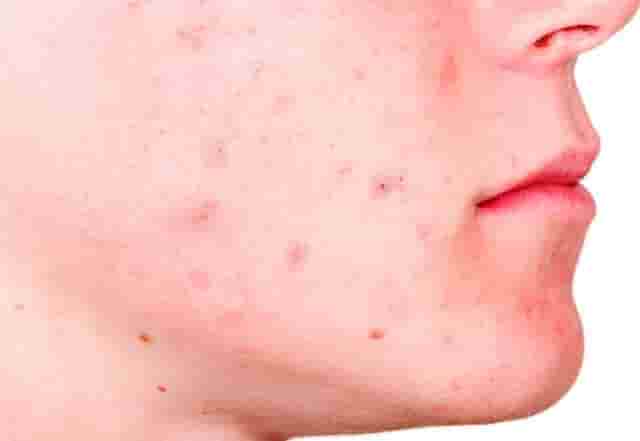 Image of Acne on Face