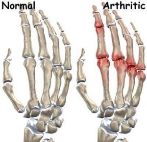 Arthritis image Normal vs Arthritic