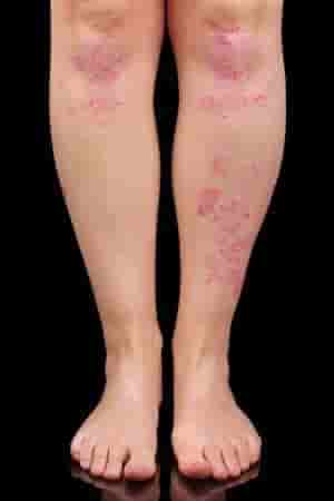 Psoriasis image on legs