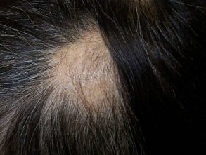 Bald spot due to Alopecia Areata