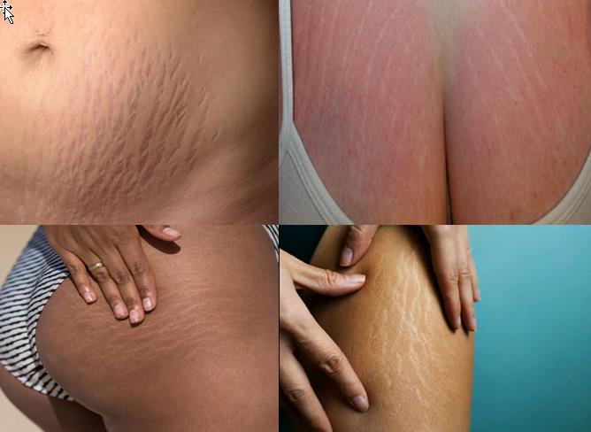 stretch marks generally appear on the stomach, breasts, thighs, and buttocks.