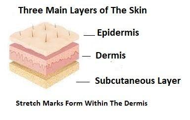 Three Main Layers of The Skin. Stretch Marks From Within The Dermis which is the Middle Layer