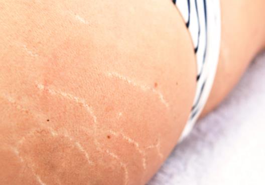 White Stretch Marks left unattended over the years to look like Silvery White scar like appearance.