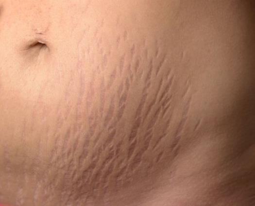 How to Treat Stretch Marks During Pregnancy