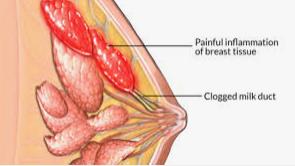 Blocked or Clogged Milk Ducts