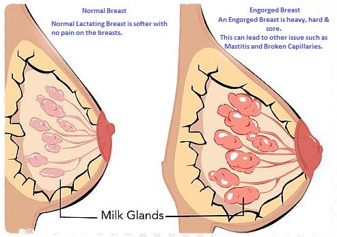 Normal Vs Engorged Breast