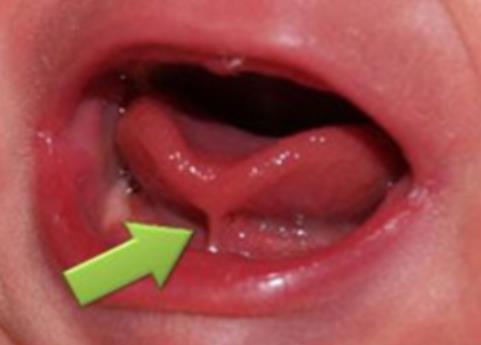 Image of Tongue-Tied Baby can create issues with cracked or bleeding nipples breastfeeding.