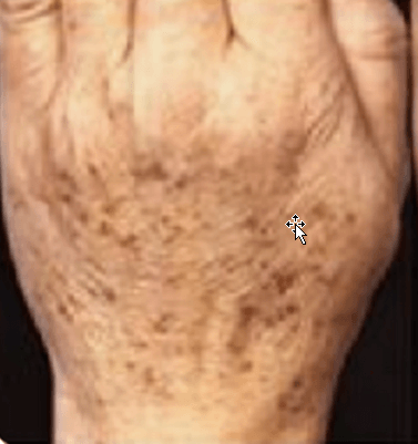Age Spots on Hand