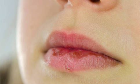 Chapped Lips or Broken Skin on Lips