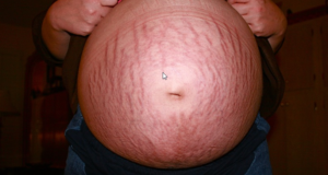 Stretch marks Due to Pregnancy