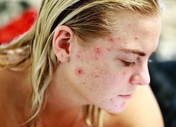 Teenage Acne Issues